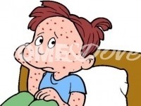 Morbillo: situazione sotto controllo. 71 casi nell’Asl To3
