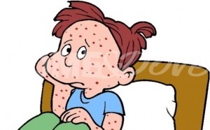morbillo-foto